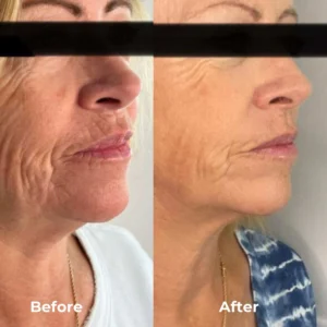 راهکار نوین جوانسازی با دستگاه RF